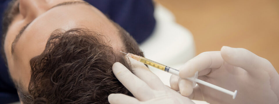 Mezoterapia igłowa skóry głowy jako pomoc na łysienie i wypadanie włosów po covidzie